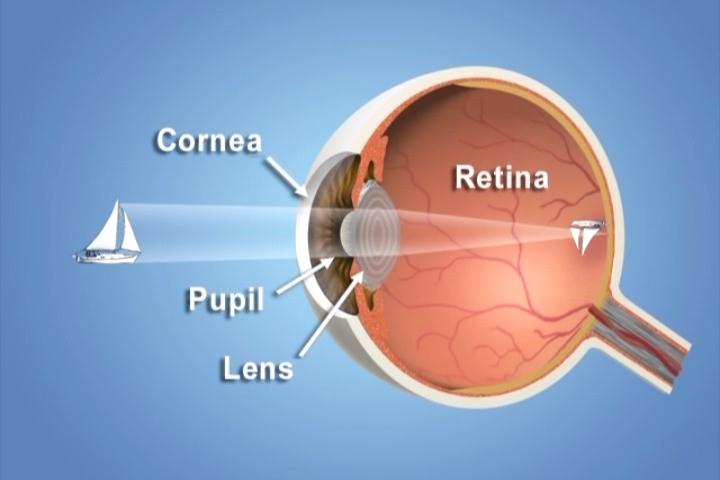 Understanding LASIK and Wavefront Patient Education