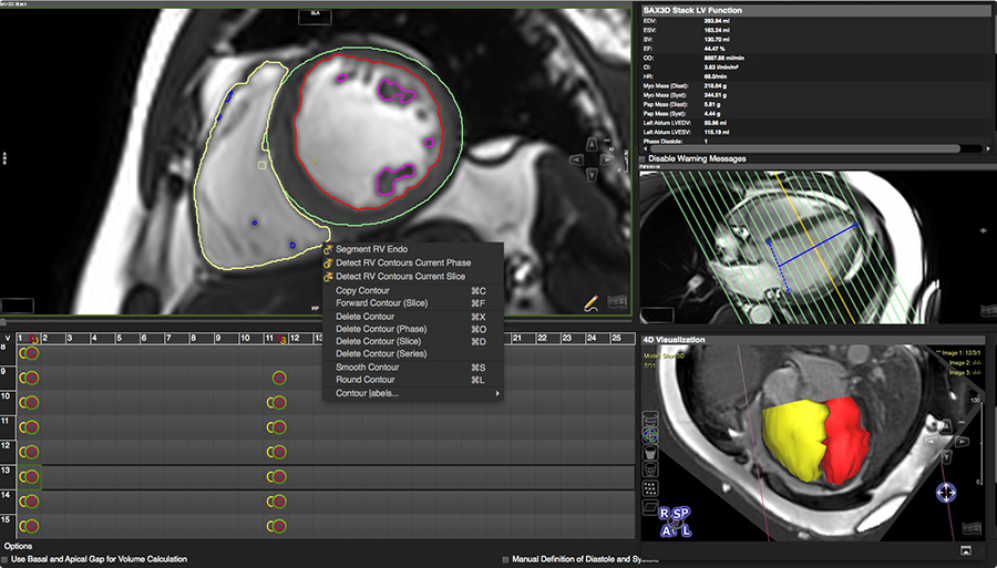 Circle Cardiovascular Imaging CVI42 v5.1.1 (x64)